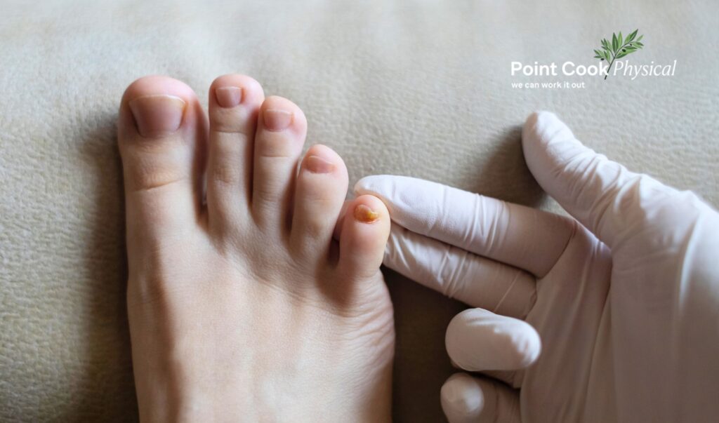 Nail Fungus Treatment Podiatry Point Cook | Point Cook Physical