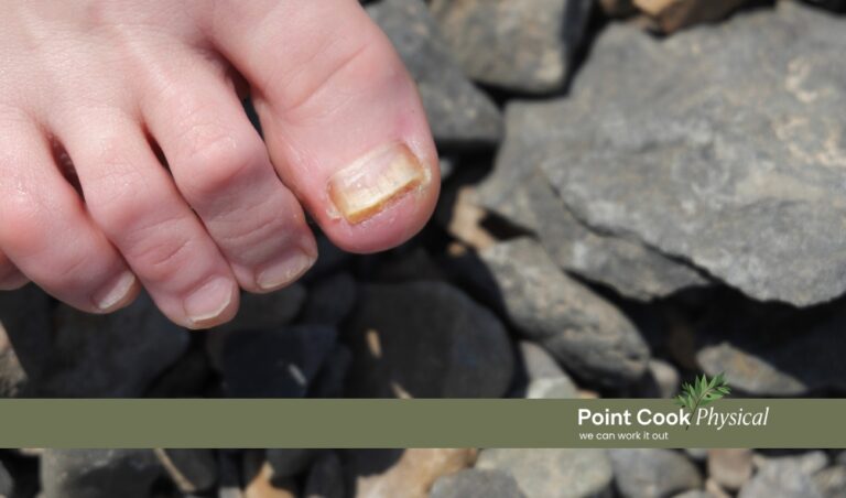 Fungal Nail Treatment Point Cook: What Your Nails Are Trying To Tell You
