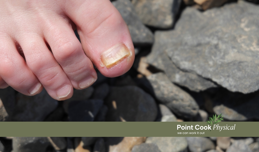 Fungal Toenail Podiatrist Point Cook | Point Cook Physical